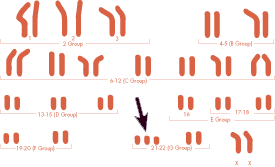 Down Syndrome Life Expectancy Chart